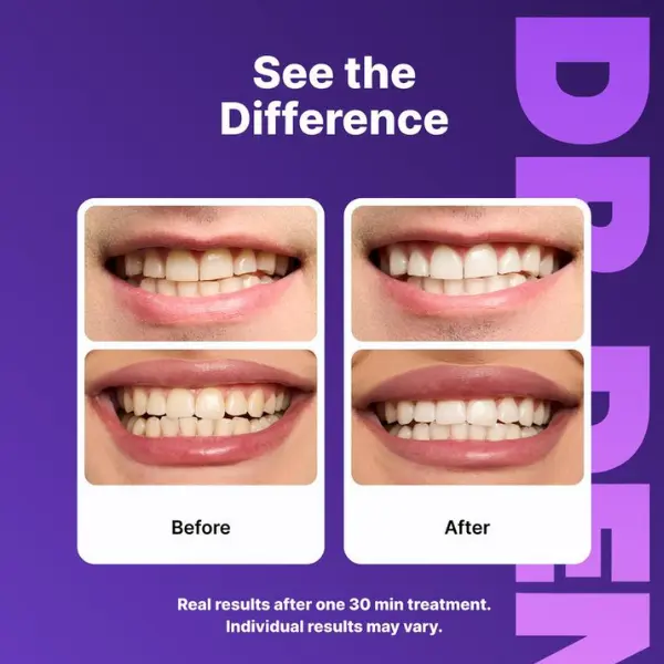 Dr Dent Purple Teeth Whitening Strips - Image 5